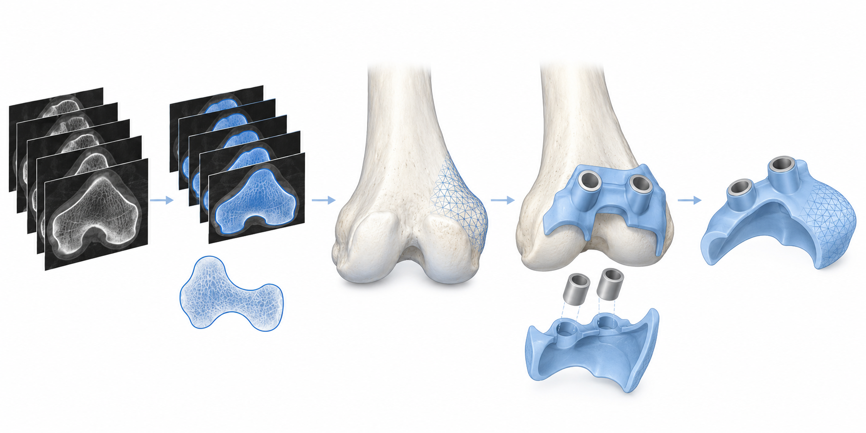 Workflow Diagram for Medical 3D-Printed Surgical Guides from DICOM Imaging to CAD Design